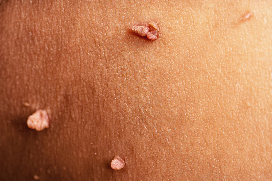 ¿Tienes “bolitas” en el cuello o axilas? Esto es lo que los dermatólogos quieren que sepas