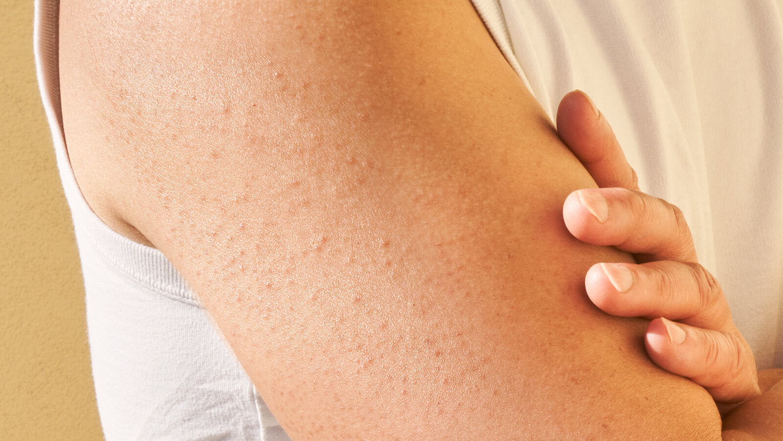 ¿Tienes piel de gallina en brazos o muslos? Podría ser queratosis pilaris
