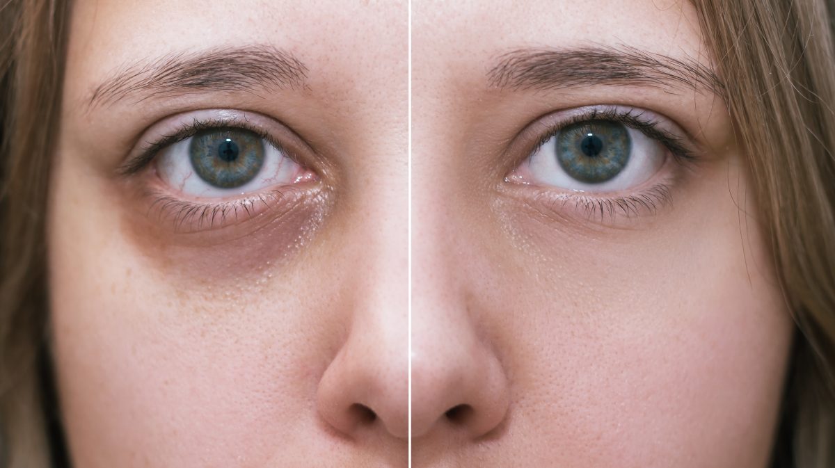 ¿Ojeras y bolsas? Prueba esto y nota el cambio en minutos