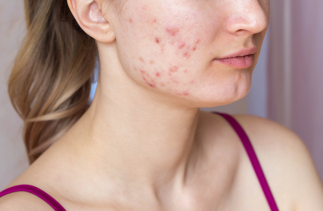 ¿Tu acné ya no mejora? Esto es cuándo debes correr al dermatólogo