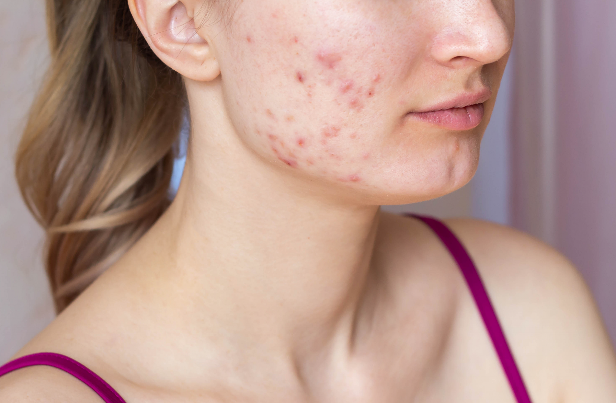 ¿Tu acné ya no mejora? Esto es cuándo debes correr al dermatólogo