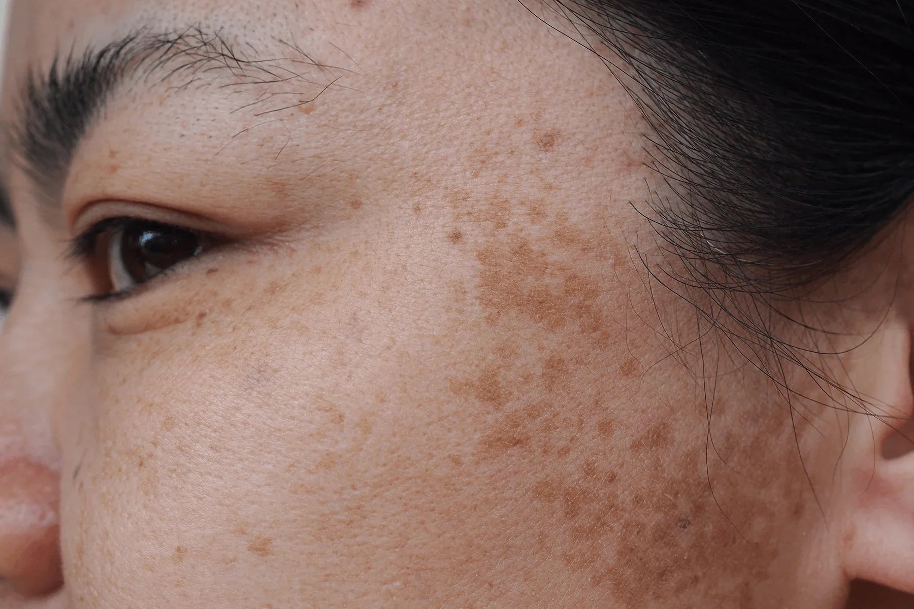 Manchas oscuras en la cara: ¿es melasma?