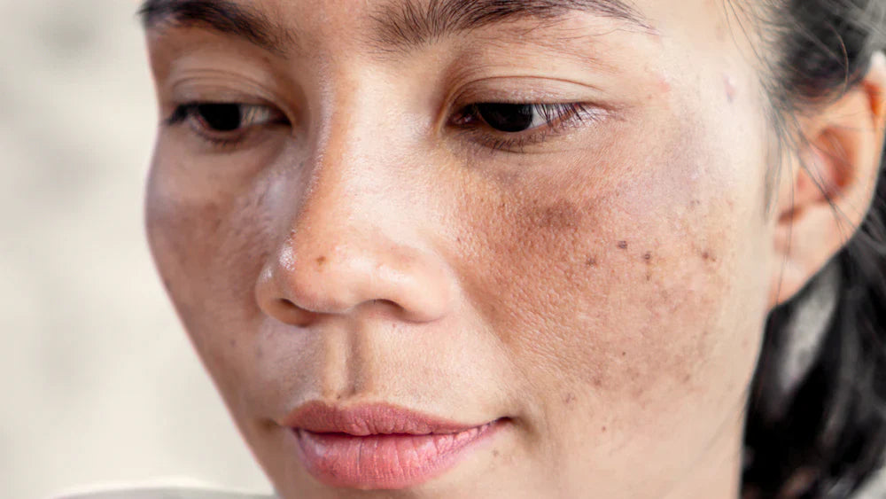 ¿Tienes manchas oscuras que no desaparecen? Esto es lo que haría un dermatólogo