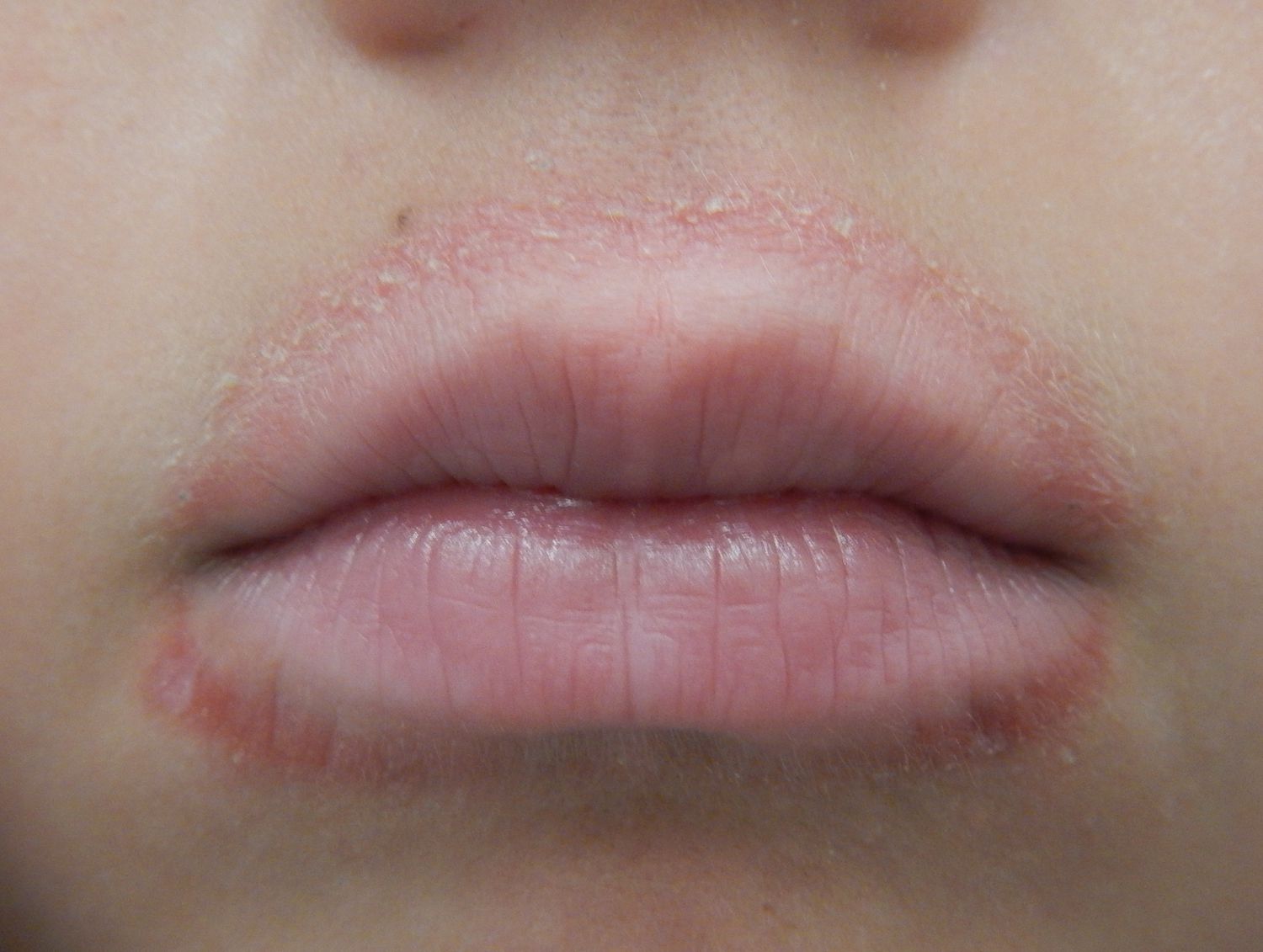 ¿Tienes brotes alrededor de la boca? Podría ser dermatitis perioral