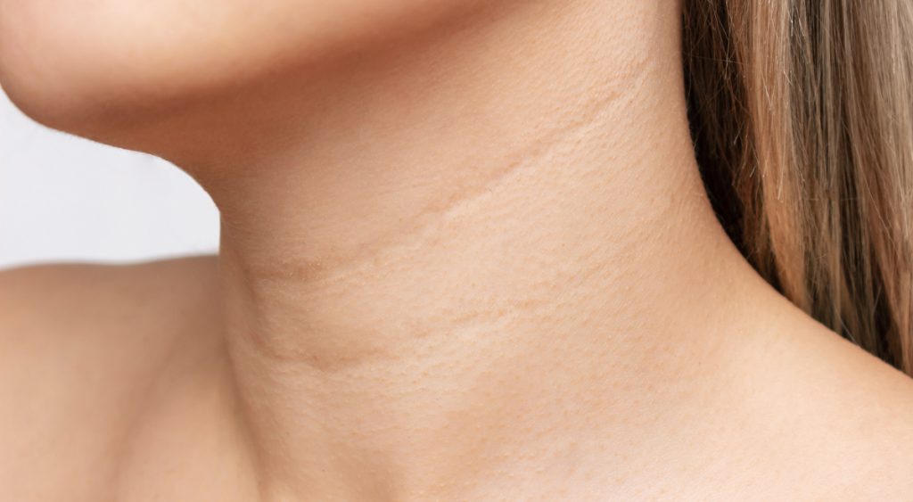 ¿Notas arrugas en el cuello? No es solo la edad, y sí tiene solución